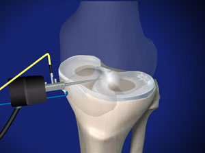 Meniscal Repair market Growth Areas, Shares, Strategy [PDF] | Driving Factors and Growth Forecast to 2031