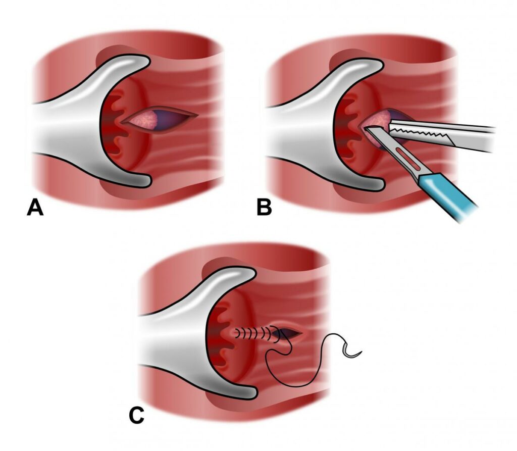 Anal Fissure Treatment