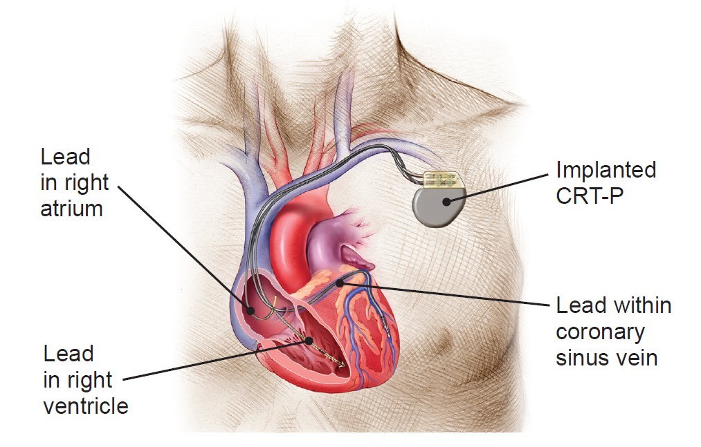 Cardiac Resynchronization Therapy Devices