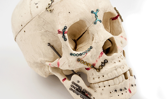 Cranio Maxillofacial Implant