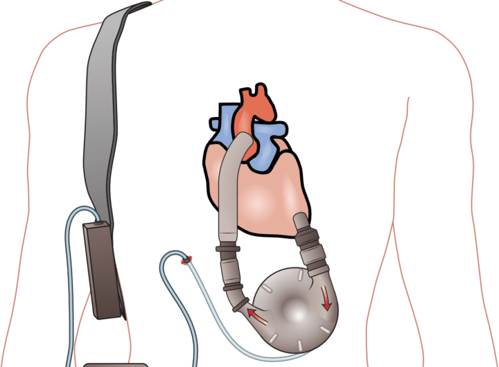 Left Ventricular Assist Device market Trend Analysis & Size to 2031 | Research Methodology and Assumptions